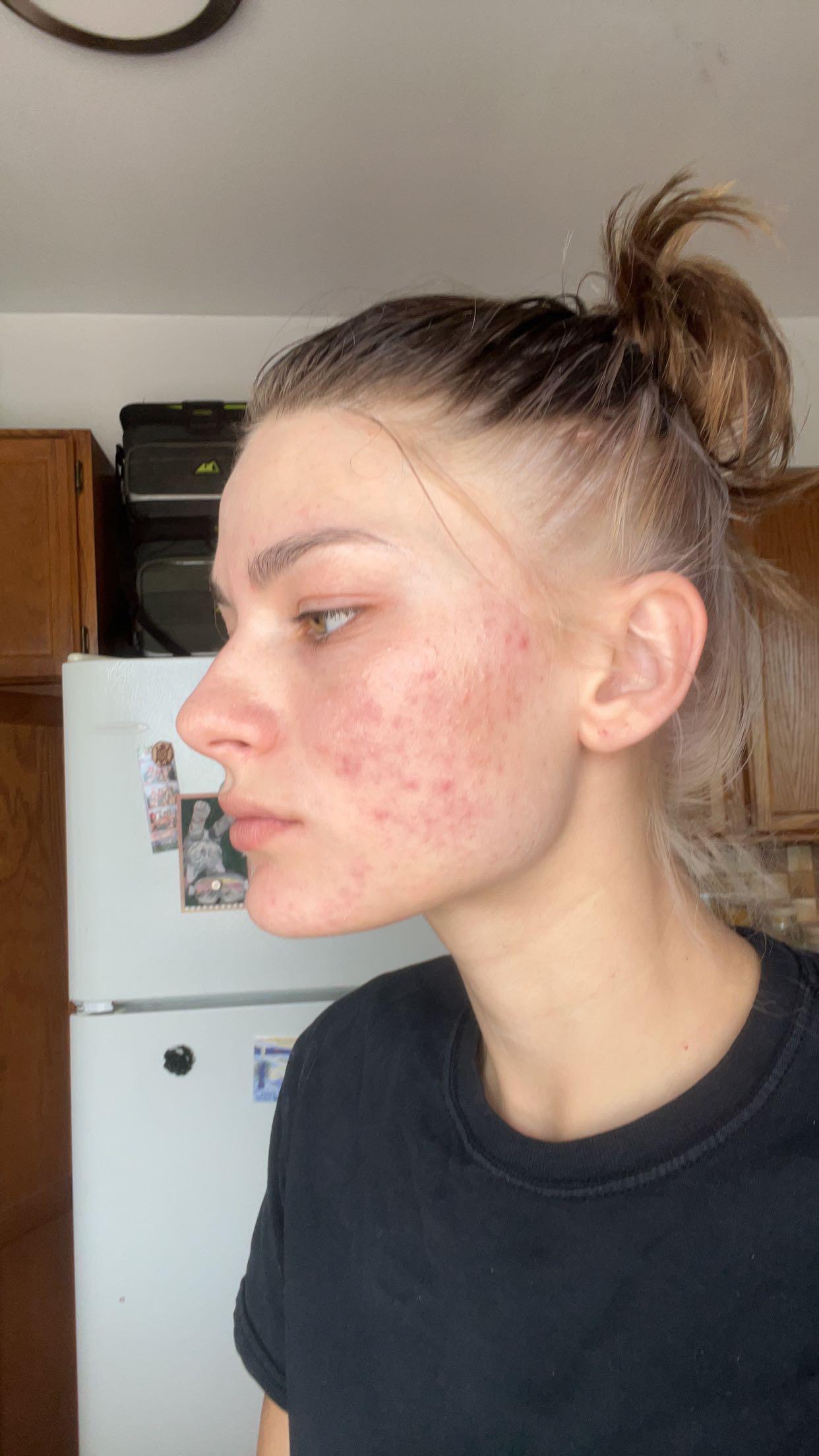 Beforeafter the power of treti4