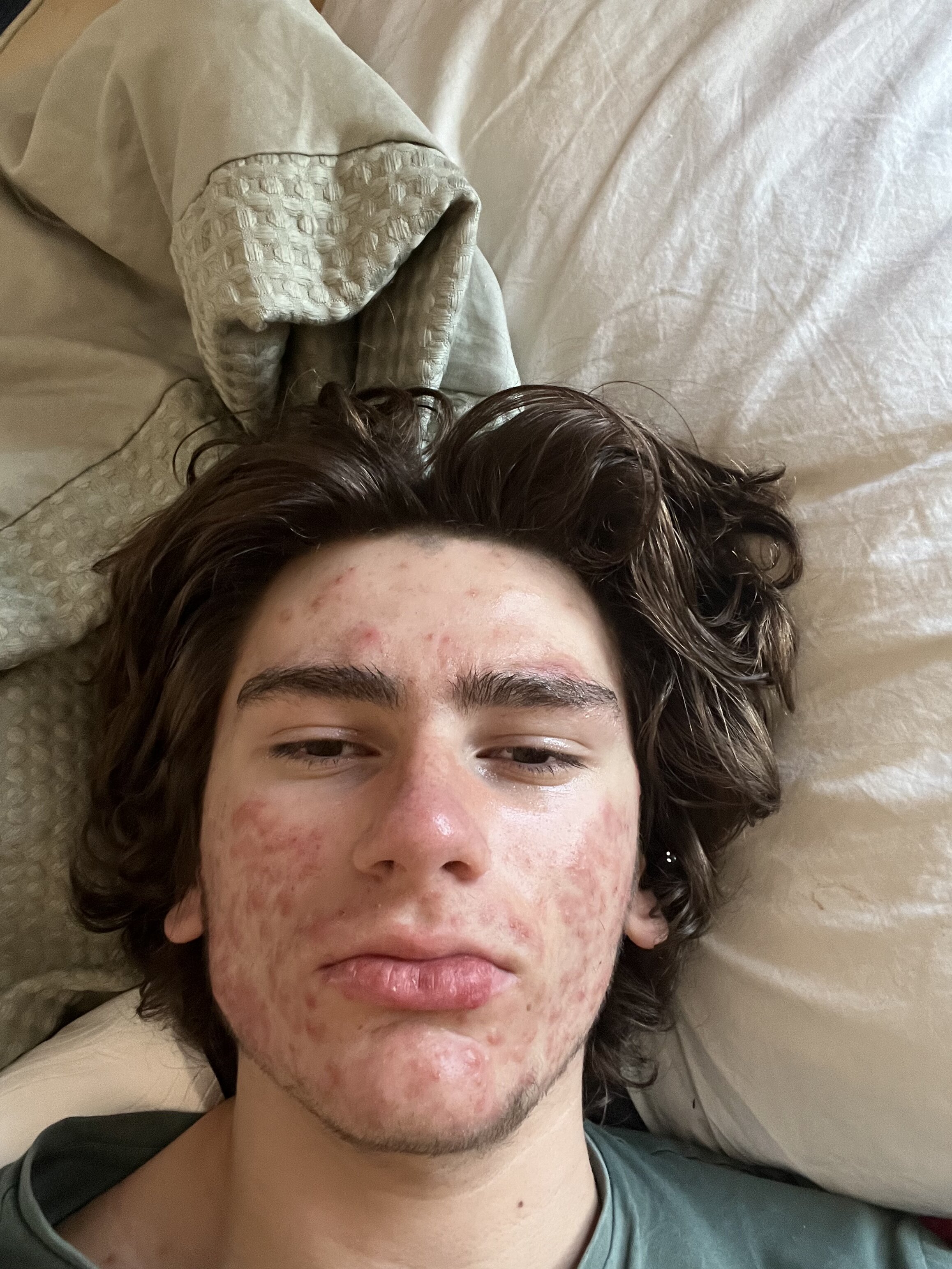 4617234 4295513 IMGacne 0301