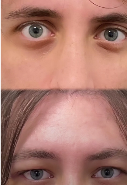Uppereyefat2