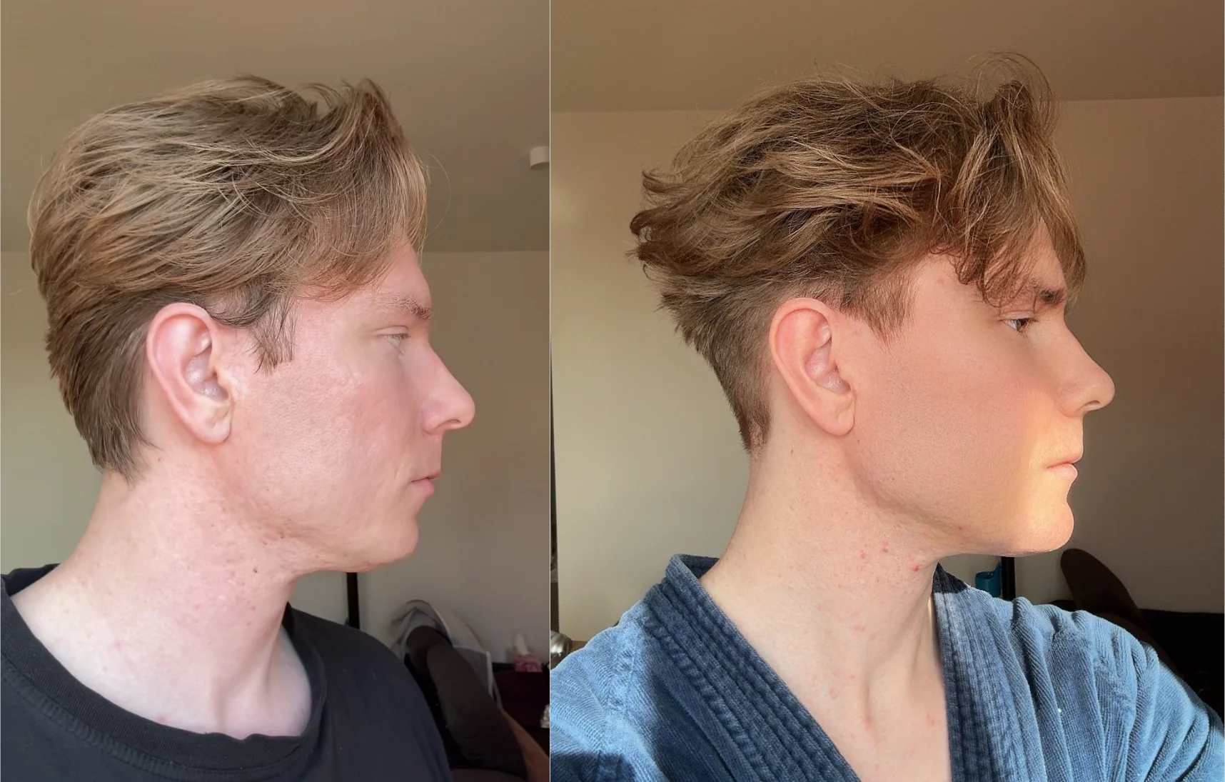 7 months post op before and after scans face all credits to v0 cqztzf8qvrde1