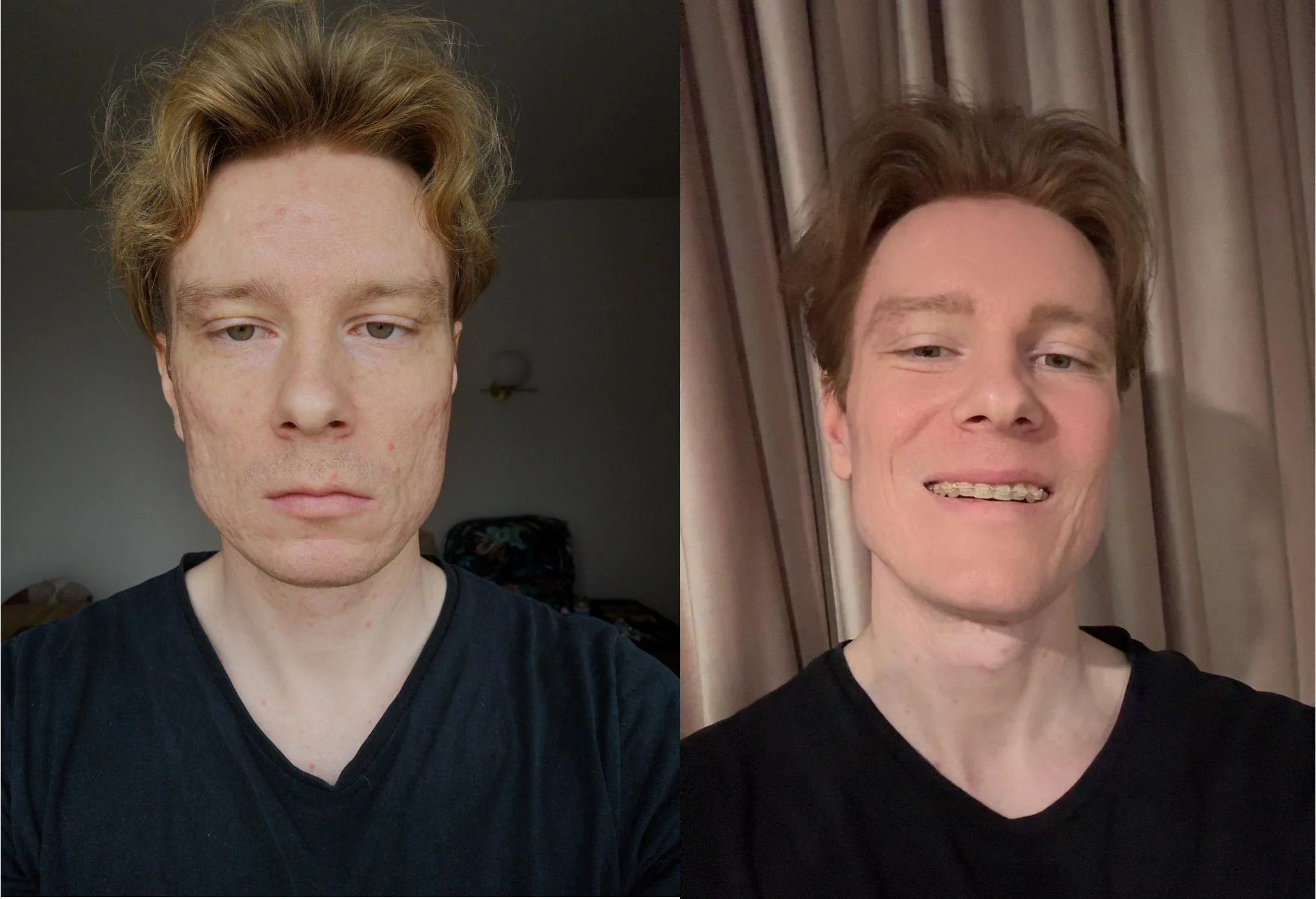7 months post op before and after scans face all credits to v0 2d59ltyqvrde1