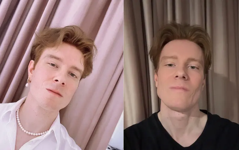 7-months-post-op-before-and-after-scans-face-all-credits-to-v0-t24dgarqvrde1.webp
