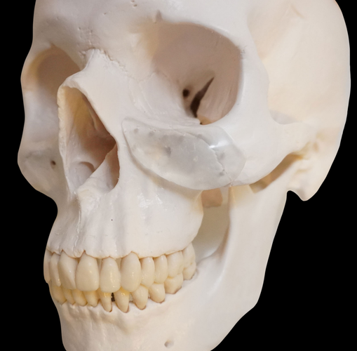 traenenrinnenimplantat-augenringe-yuveo-de-1024x1007.png