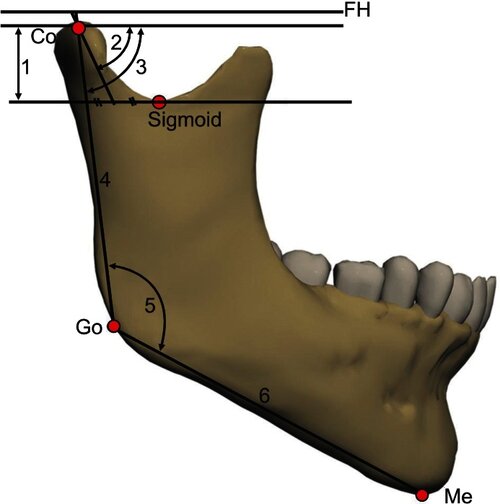 Lateral view of the mandible shows ramal and condylar landmarks and parameters FH