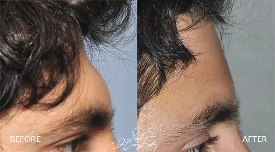 Ba male bone cement forehead augmentation side