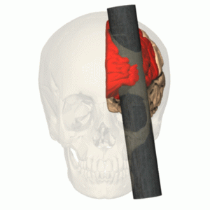 Phineas Gage injury   animation frontal lobe