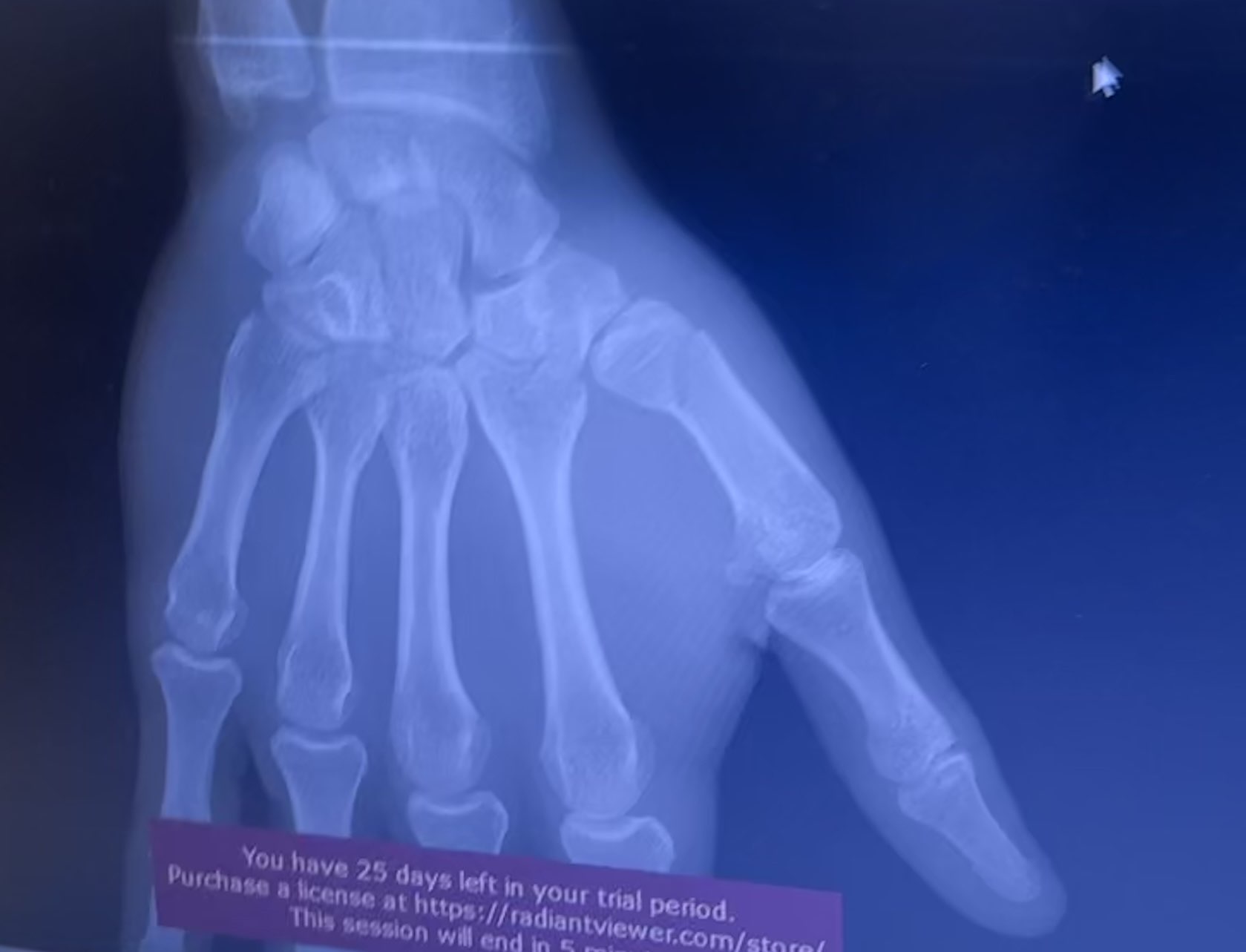 Xray1