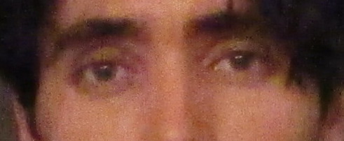 Eyebotox1