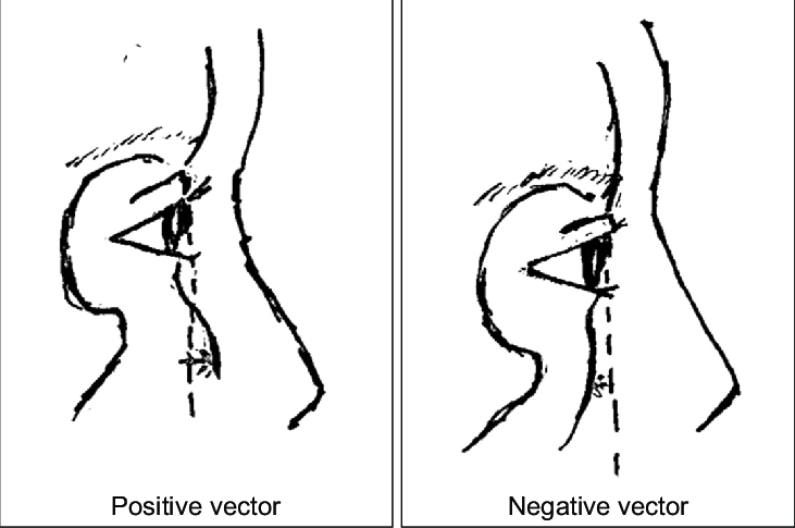 Anatomical difference between positive and negative vectors illustrating the 3506667060