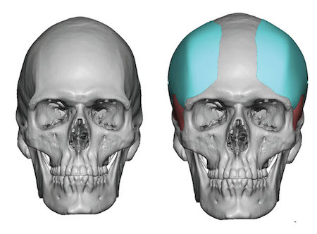 Male Custom Forehead Widening Implants Dr Barry Eppley Indianapolis