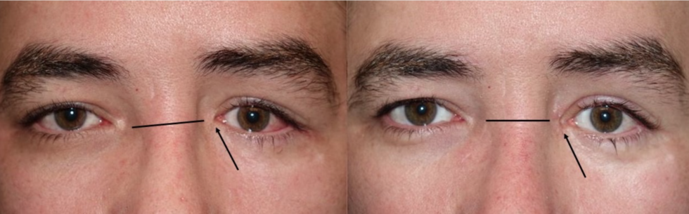 Medial canthus repair dr massry beverly hills 980x305
