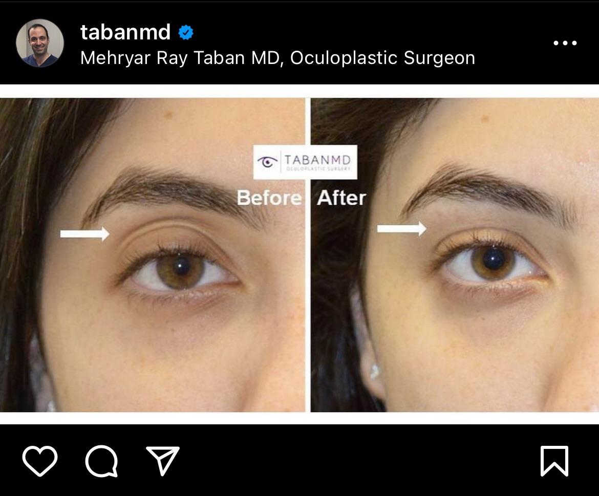 How much are dr tabans upper and lower eyelid fat transfers v0 v97tffkoprwb1