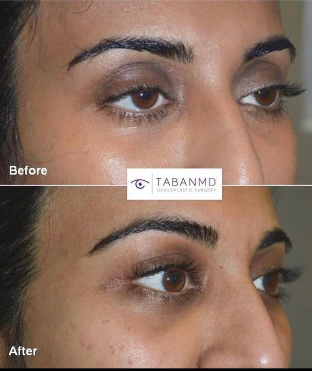 How much are dr tabans upper and lower eyelid fat transfers v0 hukabekoprwb1