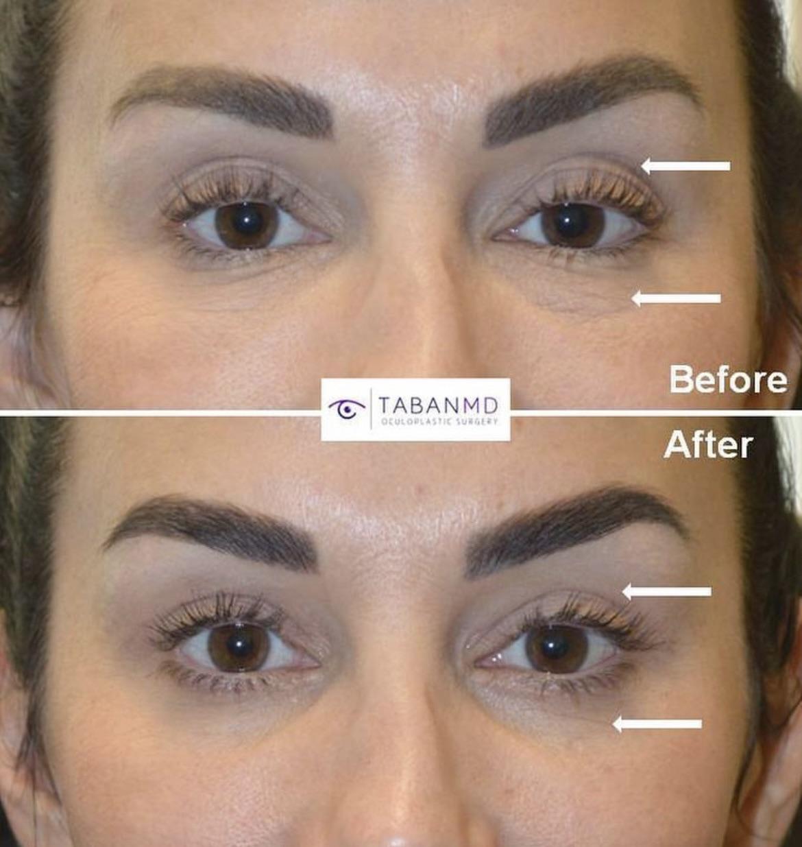 How much are dr tabans upper and lower eyelid fat transfers v0 i2dk2fkoprwb1