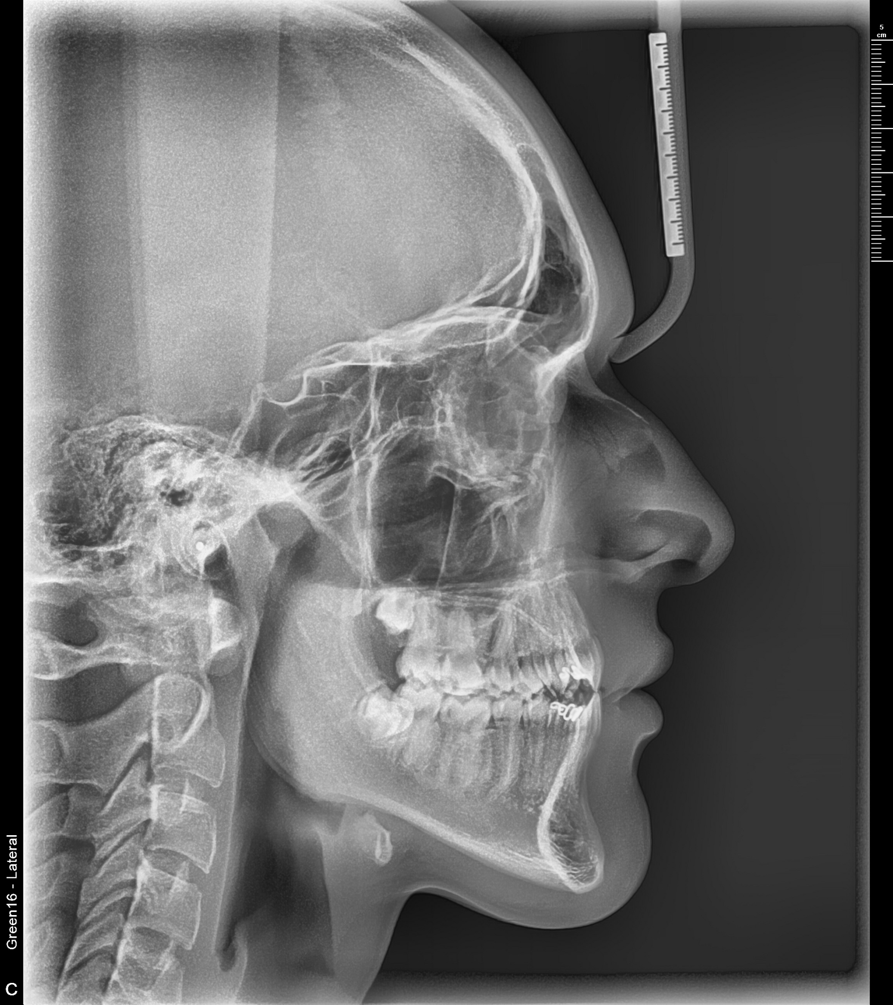 Telerradiografia