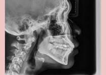 Overbite: Here's Everything You Need To Know Overbite: Here's Everything You Need To Know