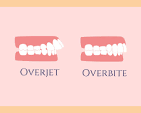 Overbite vs Overjet: What You Need to Know Overbite vs Overjet: What You Need to Know