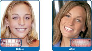 Damon® Smile Before and After - Halifax ... Damon® Smile Before and After - Halifax ...