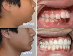 Overjet & Overbite in adult teeth ... Overjet & Overbite in adult teeth ...