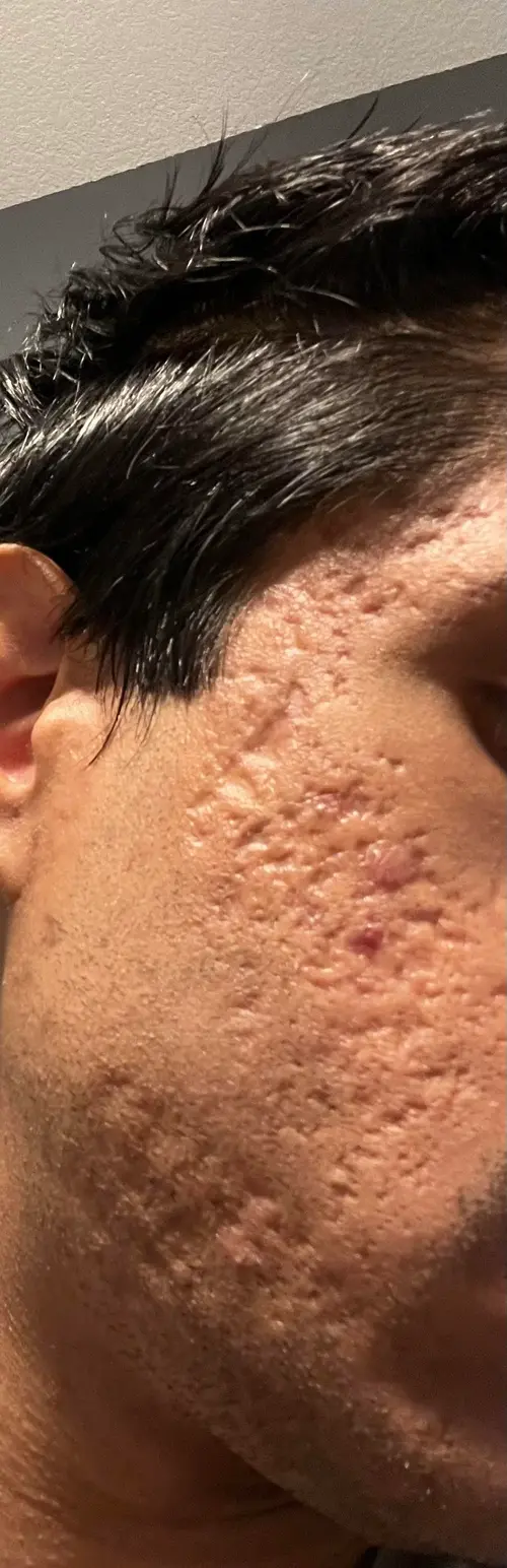 25m-extreme-very-severe-acne-scarring-on-both-sides-of-face-v0-abgs5d45shee1.webp