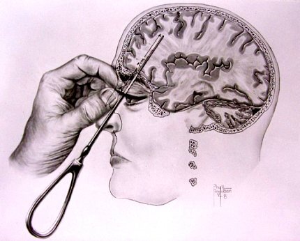 lobotomy icepick.jpg