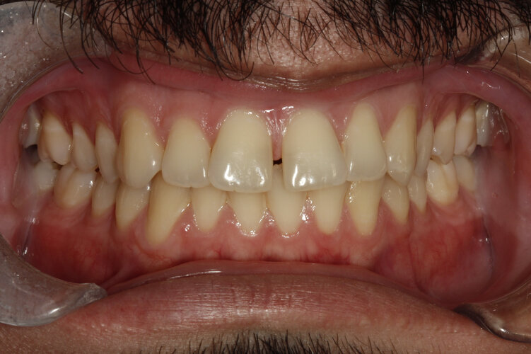 Intra-Oral-Frontal (1).jpeg