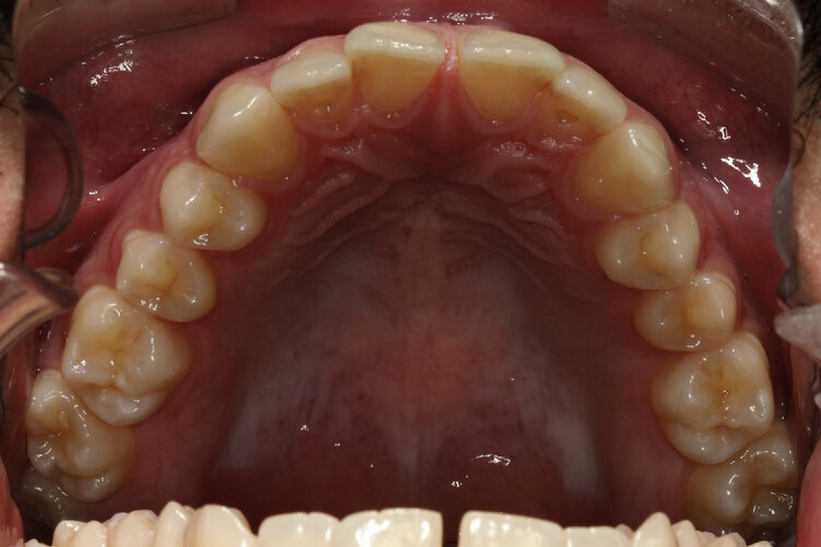 Oclusal Superior.jpeg