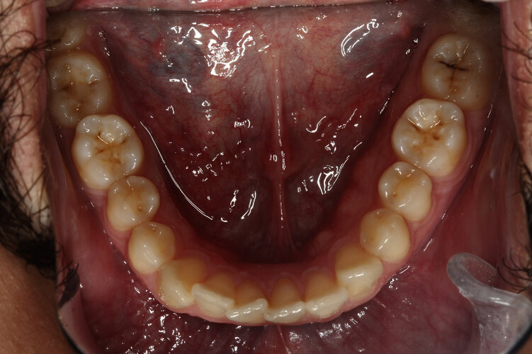 Oclusal Inferior.jpeg