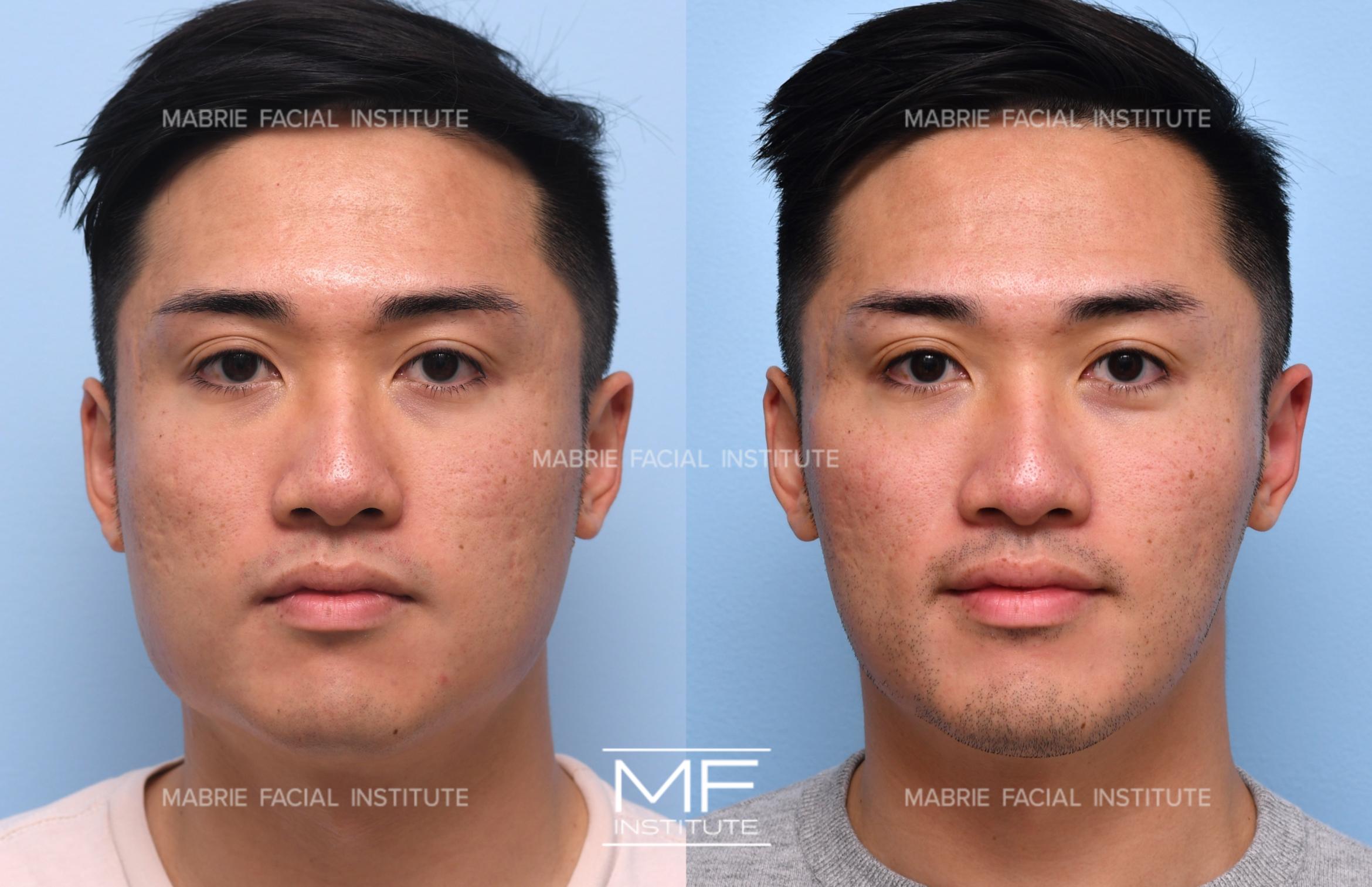 Facial slimming 1217 view 1 detail