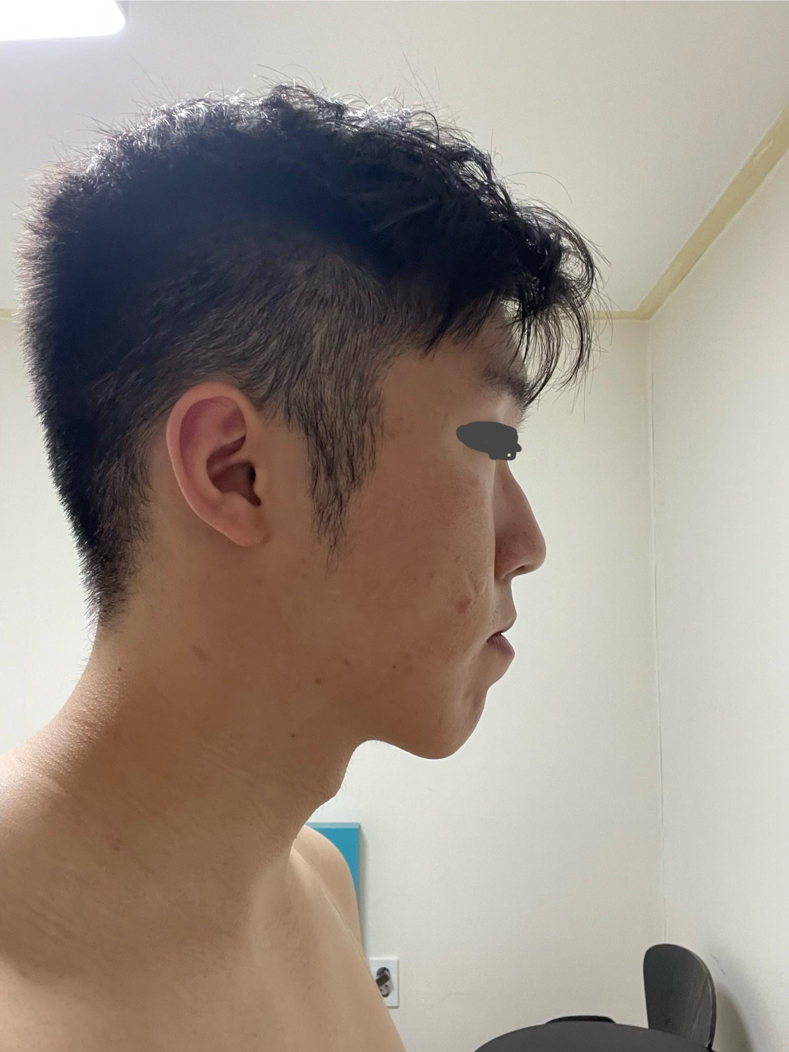 Flatface