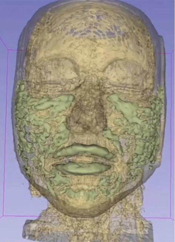 Scan of a face with years of dermal filler build up v0 r9ww56qtaycd1
