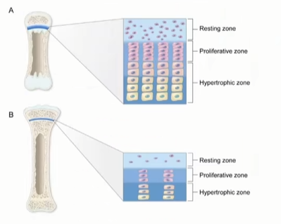 Bones  growth  zones