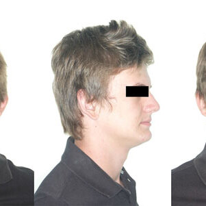 Front and lateral view facial photographs representative of an individual with the mild Q320