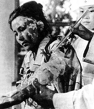 330px Victim of Atomic Bomb 003 330px Victim of Atomic Bomb 003