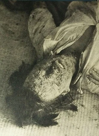 Mobilized school girl suffered burns to face Hiroshima Red Cross Hospital Mobilized school girl suffered burns to face Hiroshima Red Cross Hospital