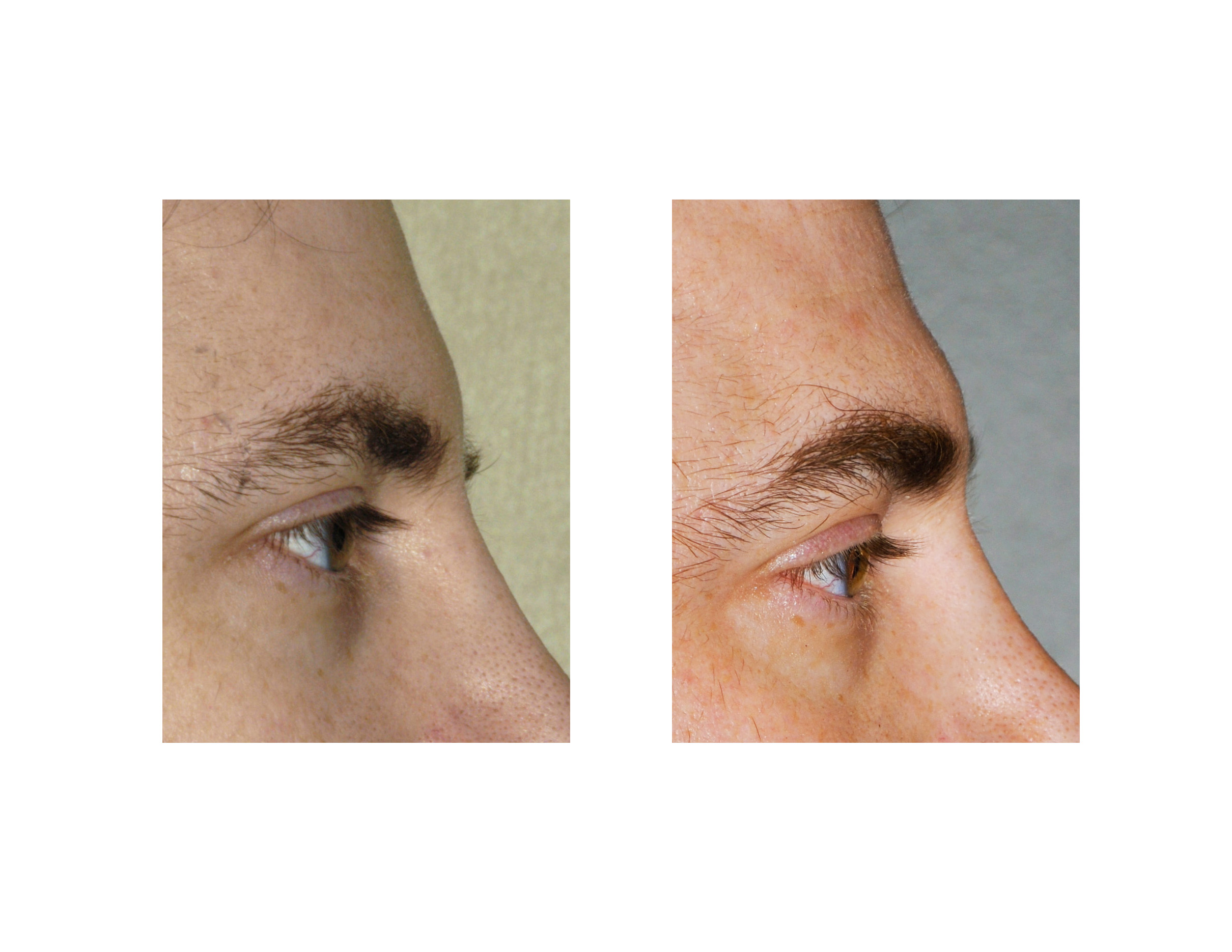 Brow Fat Injections Indianapolis Dr Barry Eppley