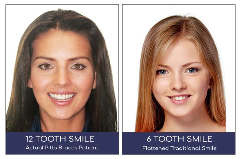 6 vs 12 tooth smile 0