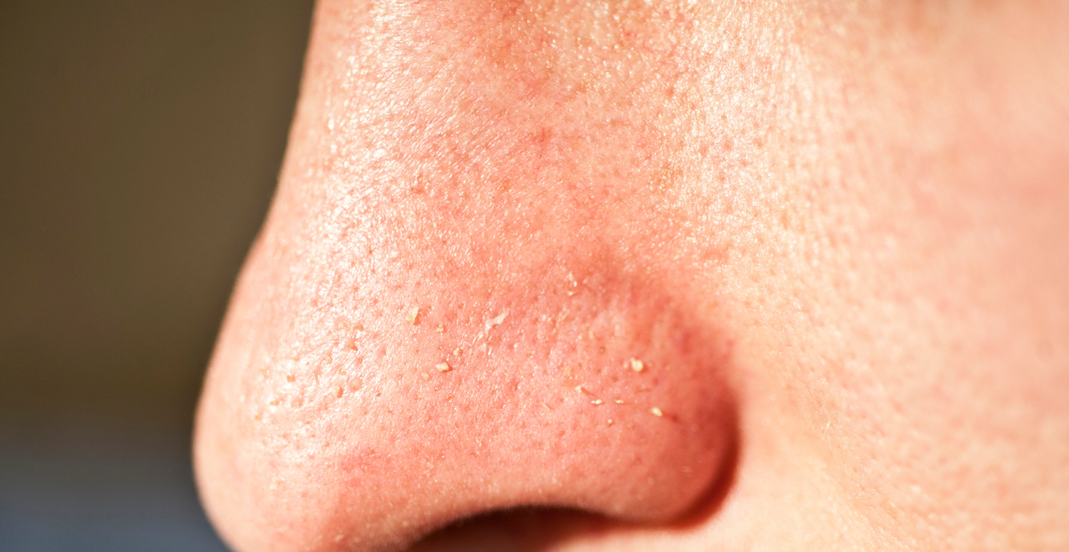 How to Get Rid of Whiteheads Permanently