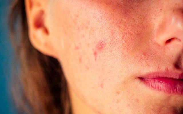 Acne Papules   Causes  Symptoms  Treatments 1024x400