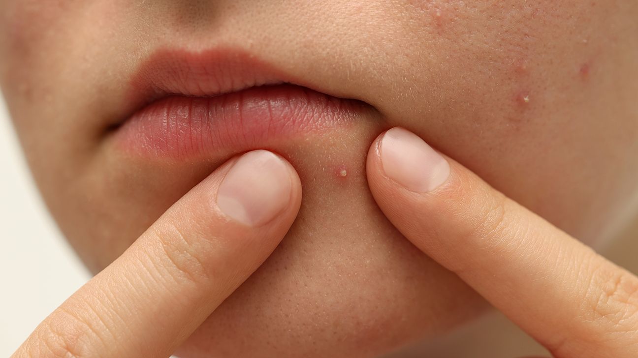 Close up woman face lip fingers touching pimple acne 1296x728 header