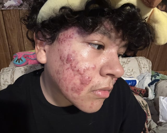 Severe cystic acne only on doxycycline treatment v0 lix64mgs0qid1