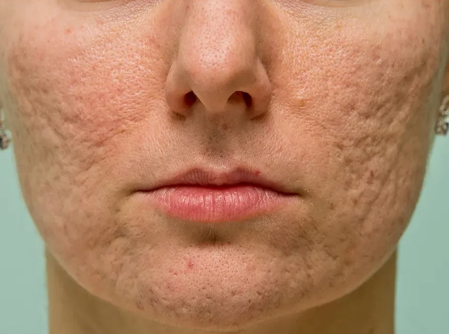 Acne scars e1703011172968