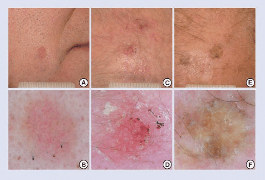 Actinic keratosis