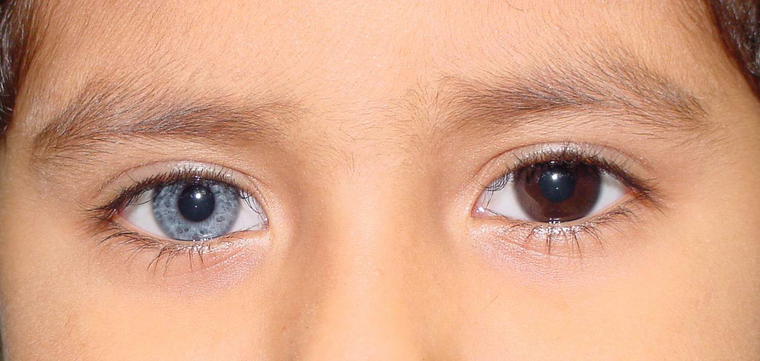 Completeheterochromia