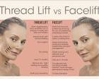 PDO Thread Lift: Your Non-Surgical Guide to a Youthful Lift ...