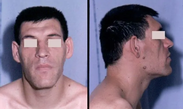 Man With Acromegaly Man With Acromegaly