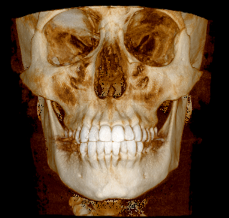 Frontal Frontal