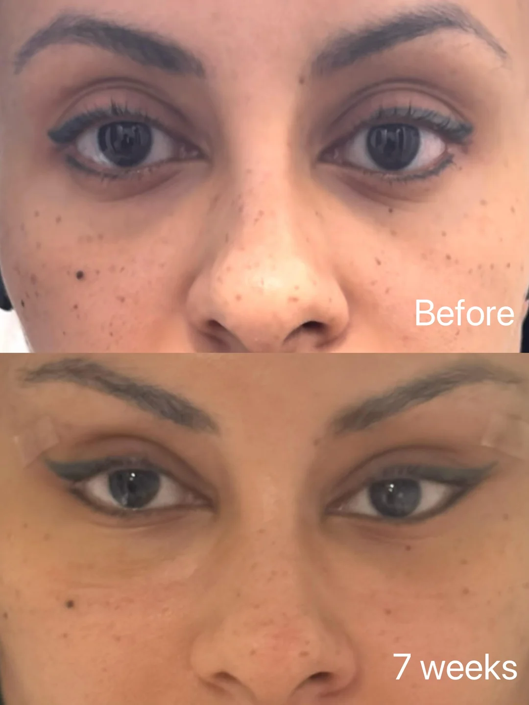 Canthoplasty failed update 7 weeks post op v0 p5p0j2fq2kie1