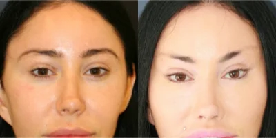 Canthoplasty before 8080203 after 8080207 0 13670870