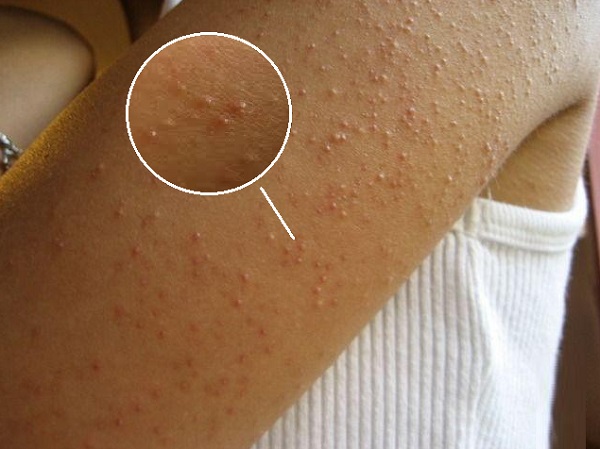 Keratosis pilaris kaz tavuk derisi keratoz pilaris pilar keratoz 2 Keratosis pilaris kaz tavuk derisi keratoz pilaris pilar keratoz 2